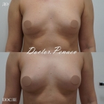 Пациентка доктора Пенаева до и после липофилинга груди