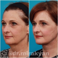 Пациентка доктора Миракяна до и после СМАС-лифтинга лица и пластизмопластики