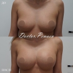 Пациентка доктора Пенаева до и после липофилинга груди