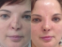 До и после реконструкции носа у Светланы Пшонкиной