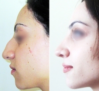 До и после ринопластики у Арташеса Айрапетяна