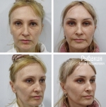 Артур Рыбакин. Периорбитопластика