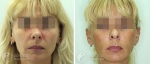 Пациентка до и после софтлифтинга