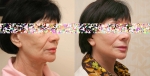Пациентка Александра Жукова до и после подтяжки лица