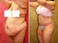 Сарвар Бакирханов. Торсопластика