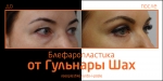 До и после блефаропластики
