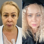 Марина Четверикова. Комплексное омоложение лица
