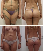 VASER липосакция  в сочетании с радиочастотной липосакцией Body Tite передней брюшной стенки, плеч и фланков, VASER липосакция пояснично-крестцовой, подмышечных областей, бедер и коленок  и  липофилинг ягодиц