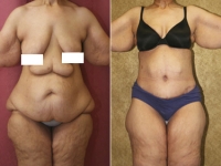 Сарвар Бакирханов. Торсопластика