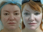 Безоперационная блефаропластика в Beauty Plaza