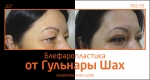 До и после блефаропластики