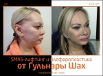 До и после СМАС-лифтинга и блефаропластики