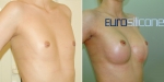 Сергей Блохин. Увеличение груди имплантами Eurosilicone