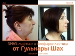 До и после СМАС-лифтинга и блефаропластики