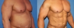 Операция «Gladiator Abs». Фото до и после