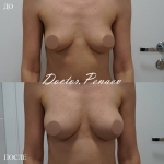 Липофилинг груди, пациентка доктора А.А. Пенаева