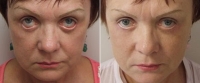 Игорь Белый. Коррекция выворота нижних век методом Cheek-lift