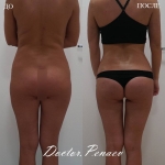 Липомоделирование тела, пациентка доктора А.А. Пенаева