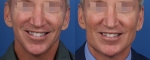 Операция «Jawline Sculpting». Фото до и после
