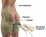 Липосакция