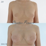 Увеличение груди, пациентка доктора А.А. Пенаева
