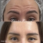 Пациентка доктора А.А. Пенаева до и после процедуры «Вечный Ботокс»