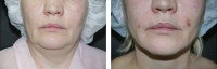 Спустя 5 дней после липосакции на Body Tite