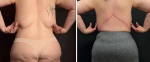 Пациентка доктора К.Г. Пайтяна до и после подтяжки спины