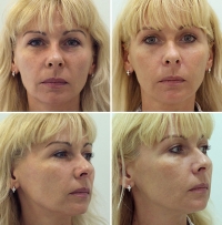 Софтлифтинг